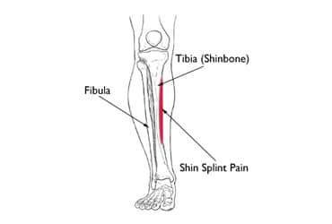 shin splints