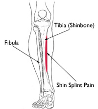 shin splints
