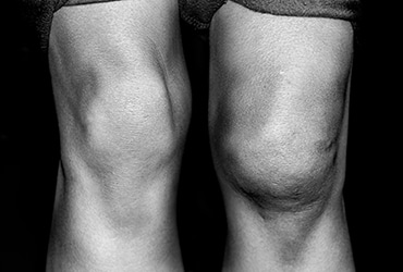 swelling