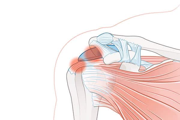 rotator cuff tendinitis